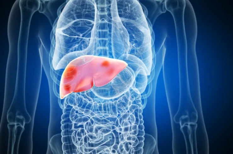 Chronic Liver Disease