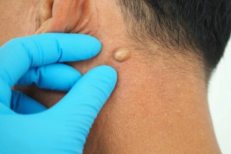 Cyst------12