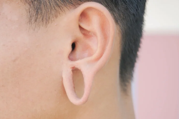 Earlobe Repair-------16