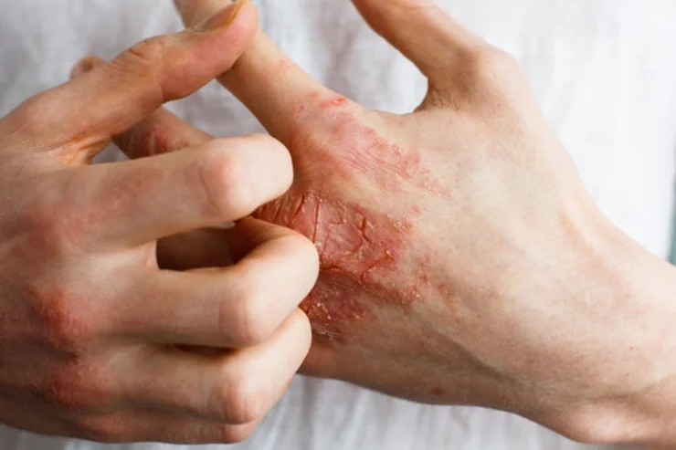 Eczema Care