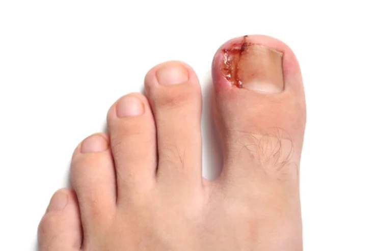 IngrownToenail------16