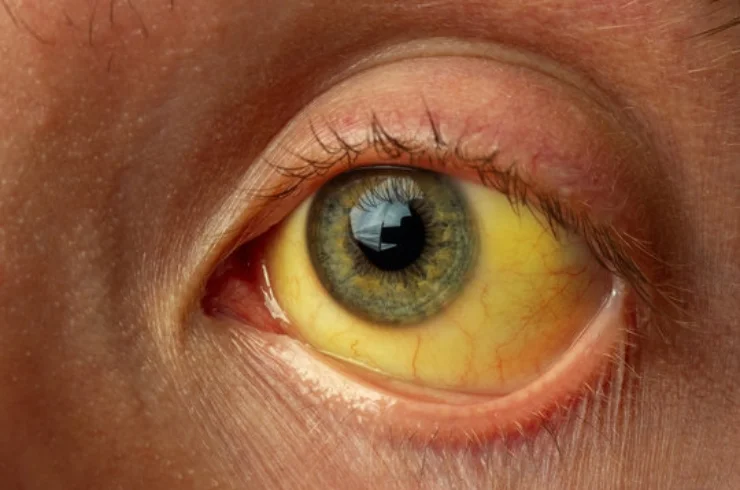 Jaundice------16