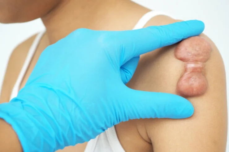 Keloid Removal