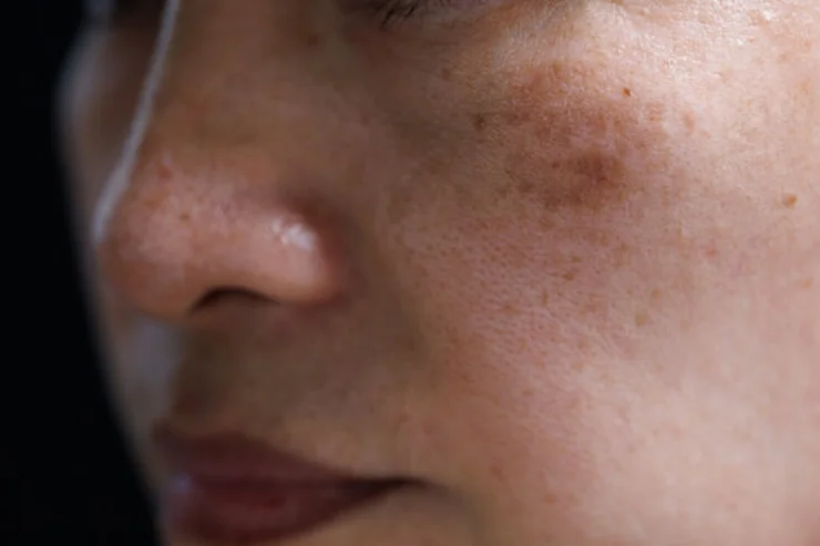 Melasma Treatment