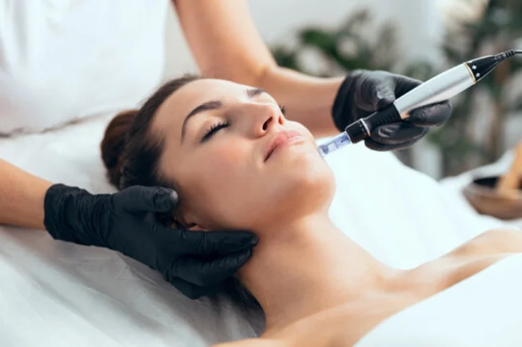 Microneedling Therapy-----16