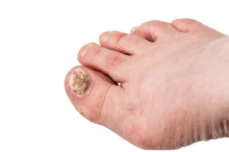 NailDisorders-------13