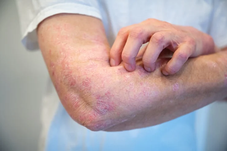 Psoriasis Treatment